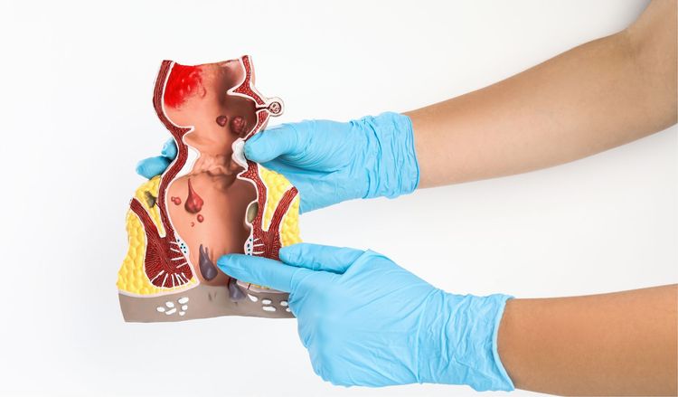 Wie Sieht Eine Analfistel Aus www.medical-laserinstitute.eu